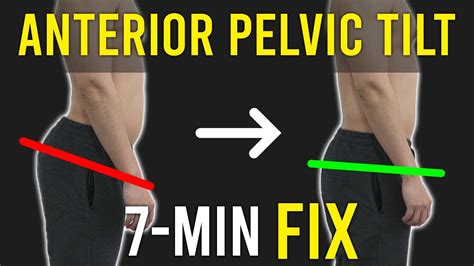 Fix The Anterior Pelvic Tiltexcessive Lower Back Arch Paincorrective