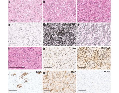 Histology And Immunohistochemistry Of Oligosarcomas He Staining Of The