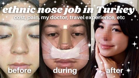 I GOT A NOSE JOB IN TURKEY Asian Ethnic Rhinoplasty With Dr