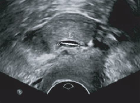 Ultrasonographic Imaging Of Cesarean Scar Diverticulum Csd After