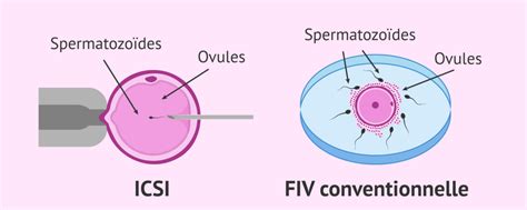 F Condation In Vitro Avec Icsi Chirurgie Online