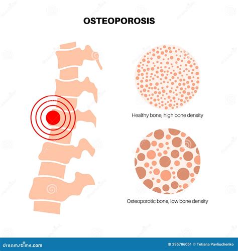 Osteoporosis Medical Poster Vector Illustration | CartoonDealer.com