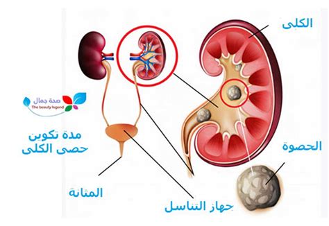 مدة تكوين حصى الكلى كيف تتكون و ما هي طرق الوقاية منها وكيف يشعر