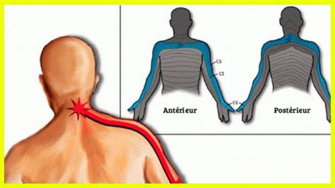 La Cervicobrachialgie Cette Douleur Qui Part Du Cou Jusquau Bras