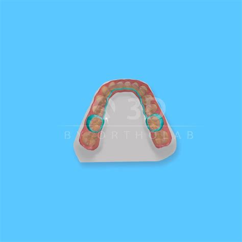 Barra Lingual - 3D by OrthoLab