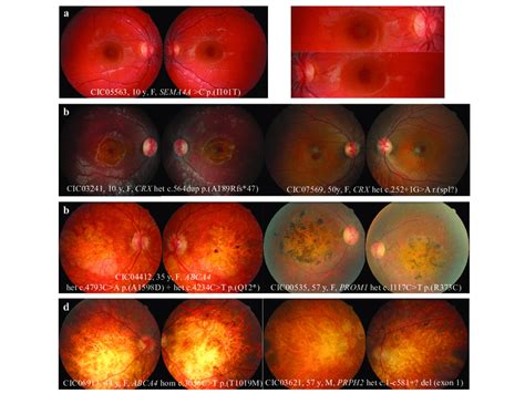 Fundus Abnormalities Observed In Cone And Cone Rod Dystrophy Cod Cord