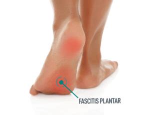 Ejercicios Para Aliviar La Fascitis Plantar Desde Casa