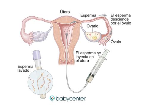 Tratamiento De Fertilidad Inseminaci N Intrauterina Iiu Babycenter