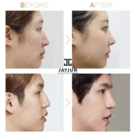 Nose Surgery In Korea Rhinoplasty Revision In South Korea Korea Nose