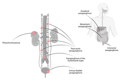 Cancers Free Full Text Pheochromocytomas And Abdominal Paragangliomas A Practical Guidance