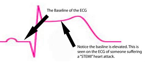 When your “significant EKG changes” are missed – Heart Sisters