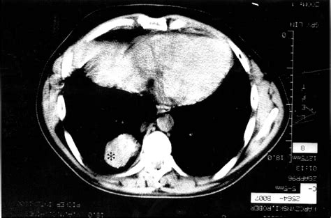 Figure From Primary Chondroblastic Osteosarcoma Of The Lung