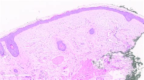 Histology Of The Left Cheek Punch Biopsy Alcian Blue And Colloidal