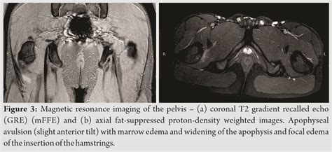 Ischial tuberosity apophysitis treatment – NSPDD