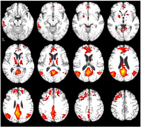 Resting State Connectivity Of The Posterior Cingulate Gyrus Mixed