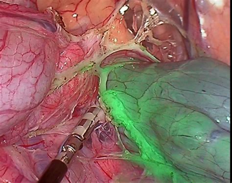 Fluorescence Guided Surgery طب پیشرو وسعت