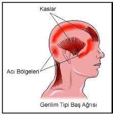 Gerilim Tip Baş Ağrısı Nedir Belirtileri ve Tedavisi