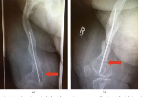 Pdf Osteosynthesis Of A Multifragment Femoral Shaft Fracture And Peri