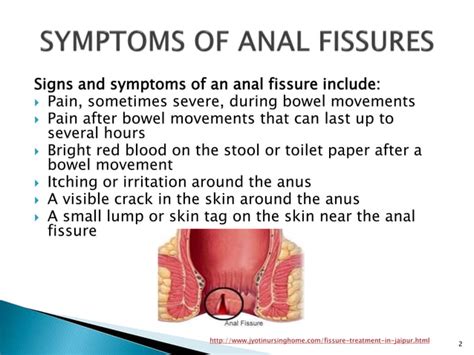 What Are Anal Fissures Symptomscausesrisk Factors And Treatment