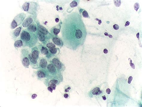Celulas Glandulares Endocervicais Presentes - Células Glandulares Endocervicais Presentes No Papanicolau - RETOEDU