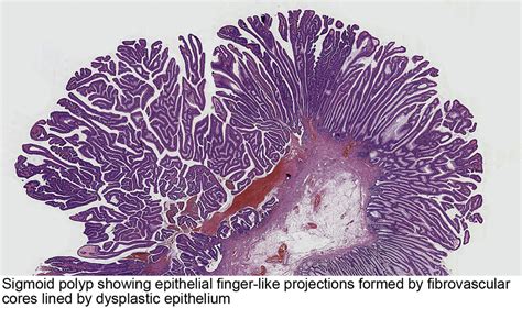 Pathology Outlines - Tubulovillous / villous adenoma