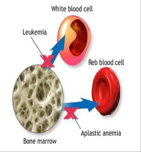 Aplastic Anemia Medizzy