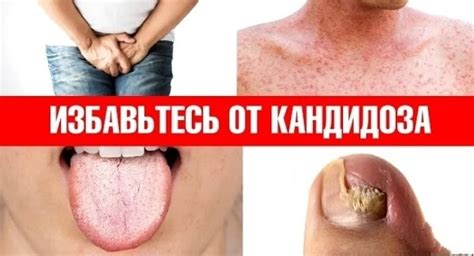 ☀️КАК ИЗБАВИТЬСЯ ОТ КАНДИДЫ🔥 ⠀ Интересный контент в группе Чудо Исцеления натуропатия