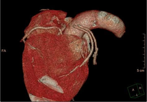 Followup Computed Tomography Coronary Angiogram Threedimensional