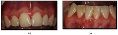 Linear Gingival Erythema