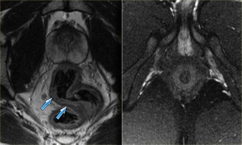 Fistula In Ano Mri