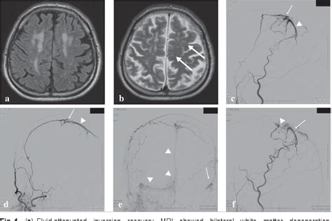 Figure From Dural Arteriovenous Fistula On The Wall Of The Superior