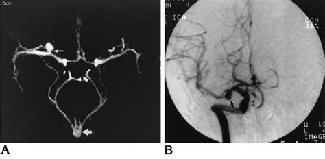 Missing Posterior Communicating Artery