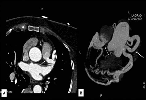 axial ct coronary angiography image showing origin  left coronary