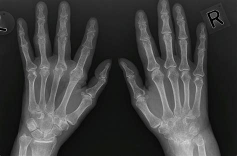 Erosive Arthritic Condition RA Undergraduate Diagnostic Imaging