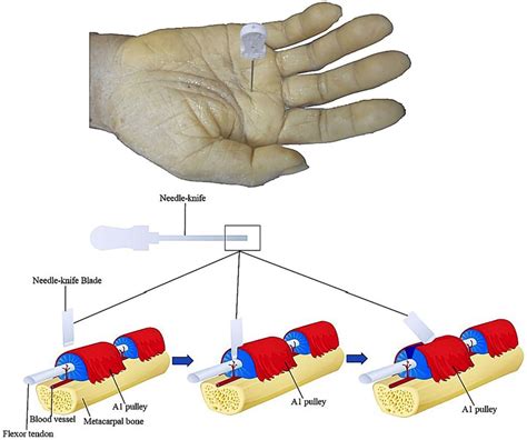 Frontiers Safety And Efficacy Of Ultrasound Guided Percutaneous A1