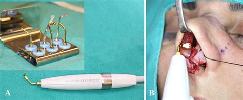 A Handpiece And Tips Of Piezo Surgery Device B Intraoperative View