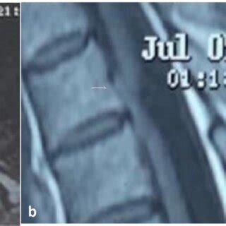 Preoperative MRI In Case 1 A Axial T2 MRI And B Sagittal T1 MRI