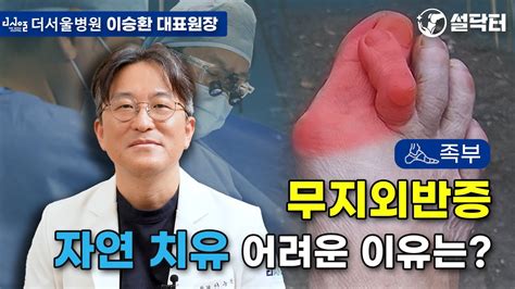 무지외반증 자연치유가 어려운 이유 발가락통증이 있다면 초기부터 병원 치료가 답 설닥터 YouTube