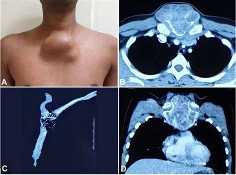 Primary Malignant Giant Cell Tumor Of The Sternum Abstract Europe PMC