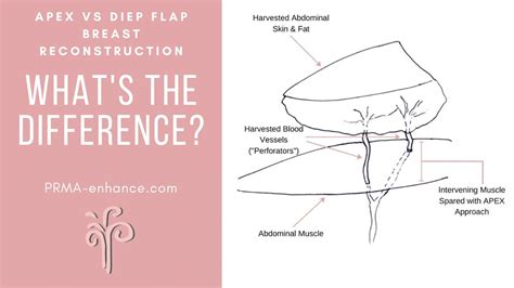 Apex Vs Diep Flap Breast Reconstruction Whats The Difference Youtube