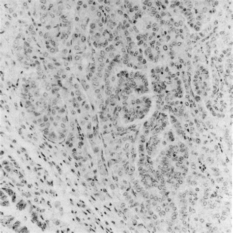 Clara cell antigen in normal Clara cells in bronchiole (lower left) but... | Download Scientific ...