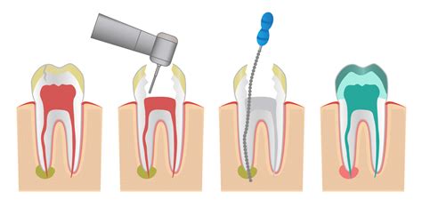 Endodoncia Cl Nica Dental Morales