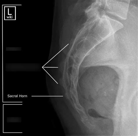 Lateral Coccyx Xray