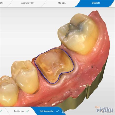 3D Skeniranja U Stomatologiji Novadent Dental Centre Novi Beograd