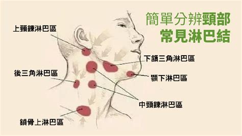 脖子、頸部有腫塊或淋巴結腫大恐是癌！醫師教你3招分辨腫瘤良性或惡性硬塊癌症代謝｜健康20