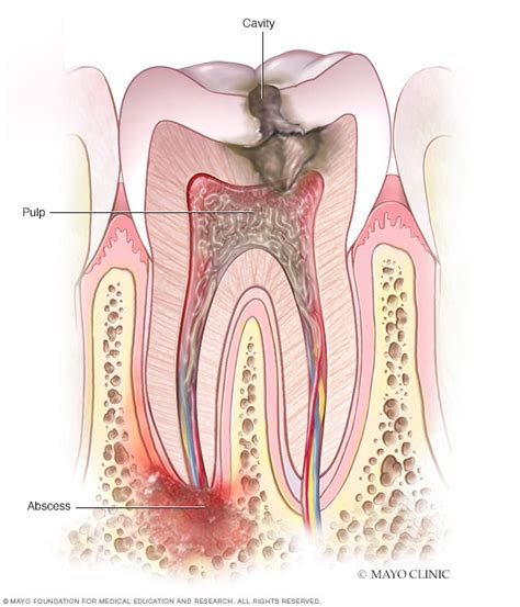 Tooth Abscess Disease Reference Guide