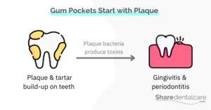 Infected Gum Pocket: Causes & Treatment - Share Dental Care