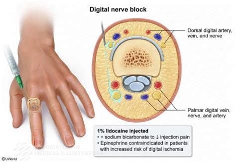 Digital nerve block | AMI Meeting 2021