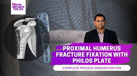 Philos Plate Fixation Procedure For Proximal Humerus Fracture Youtube