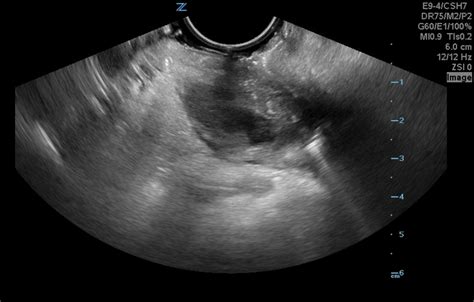 Hennepin Ultrasound | Peritonsillar Abscess Drainage